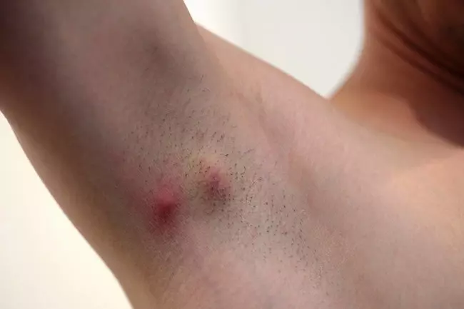 Myth-Busting Hidradenitis Suppurativa